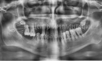 Восстановление зубов при пародонтозе - Фотография 3